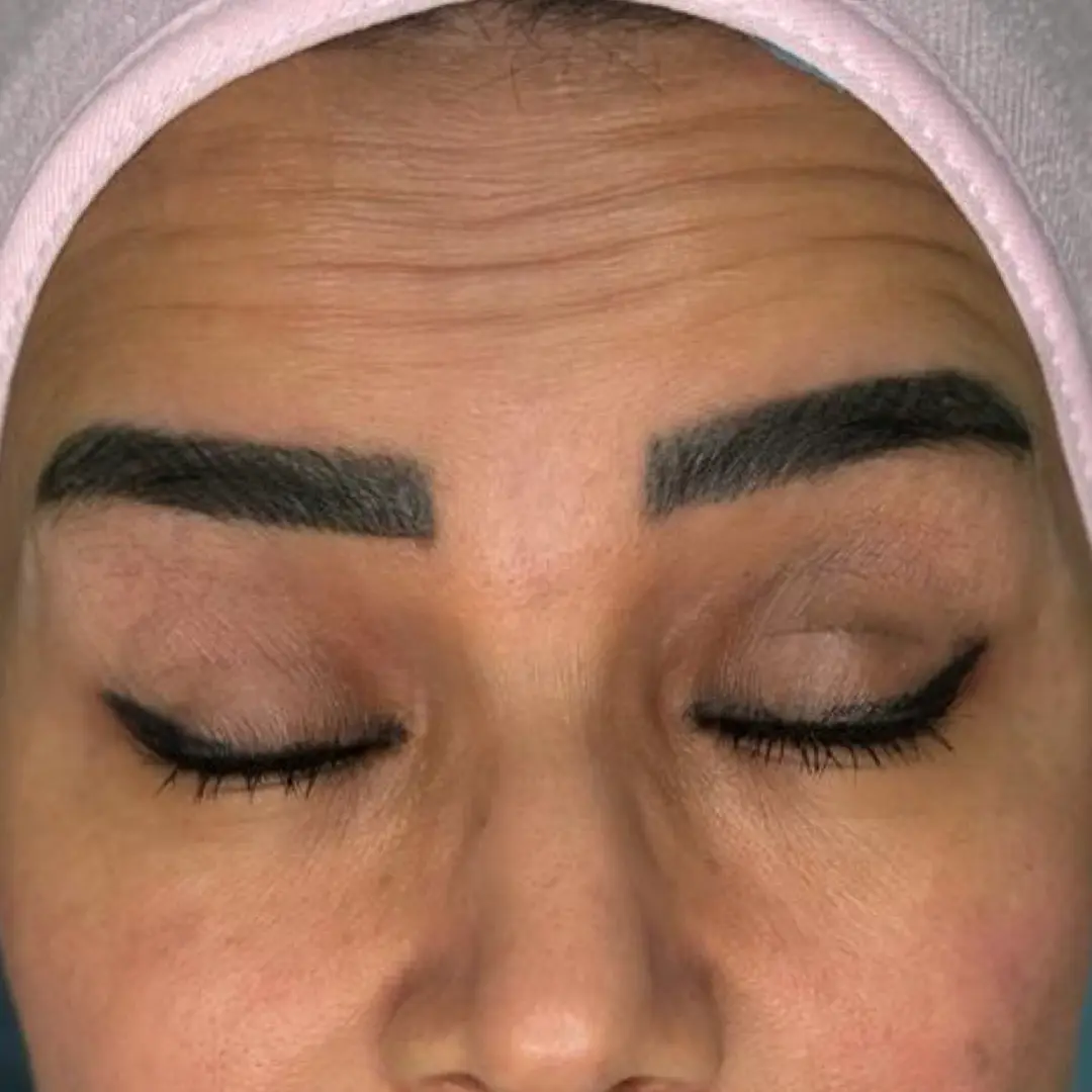 Before Treatment