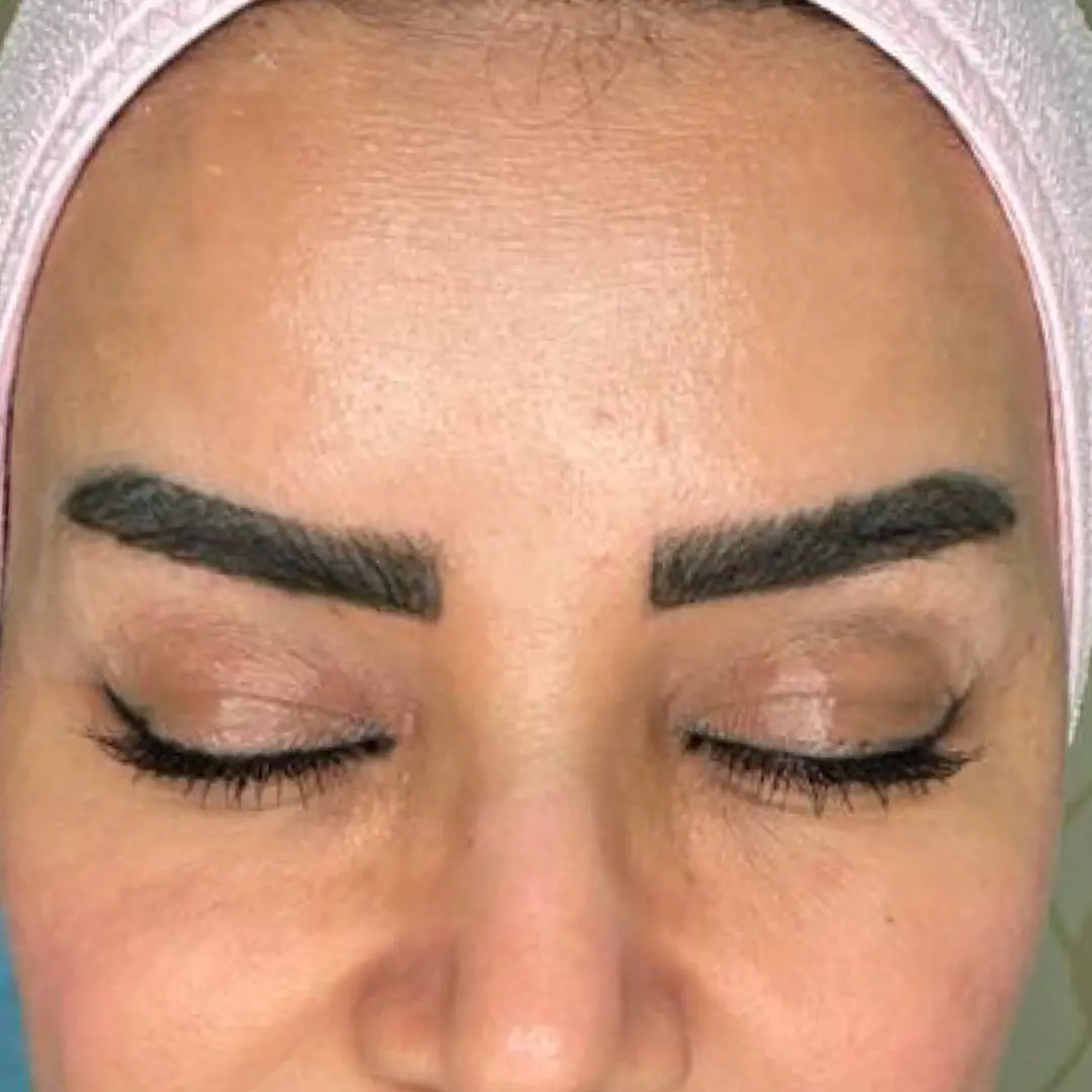 After Treatment