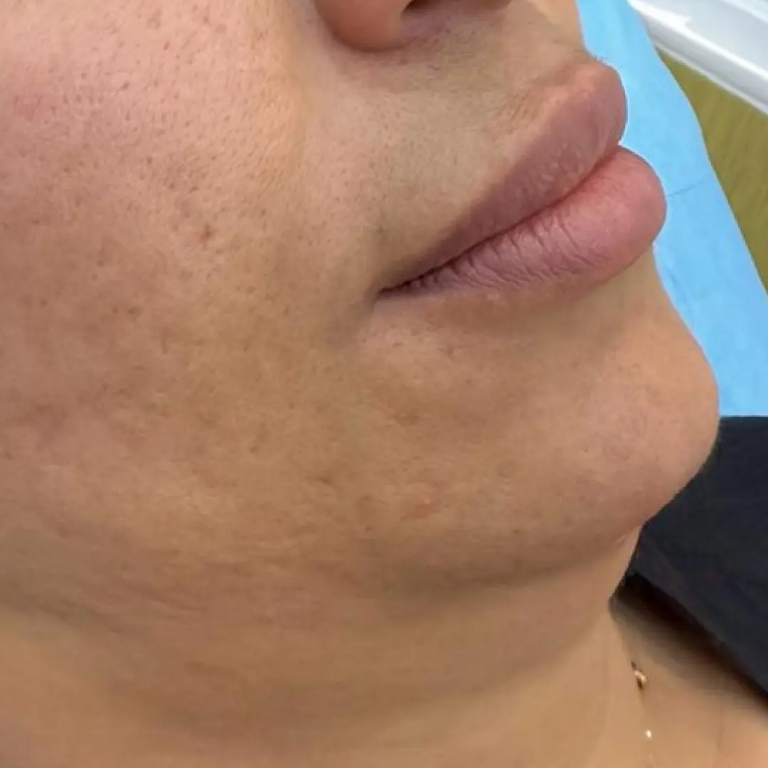 Before Treatment