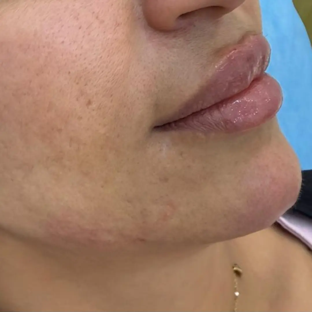 After Treatment
