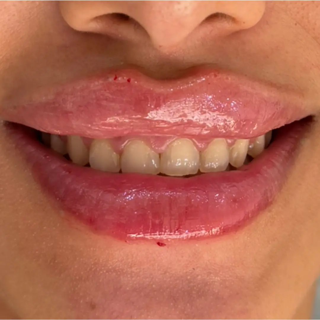 After Treatment