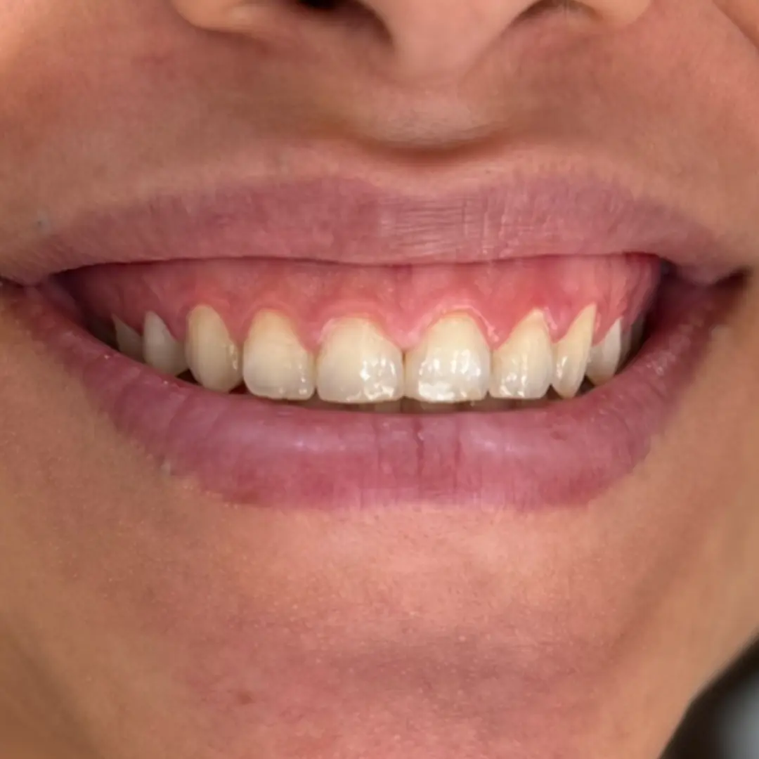 Before Treatment