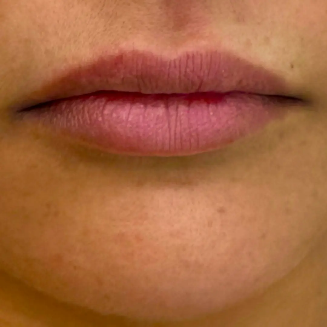 Before Treatment