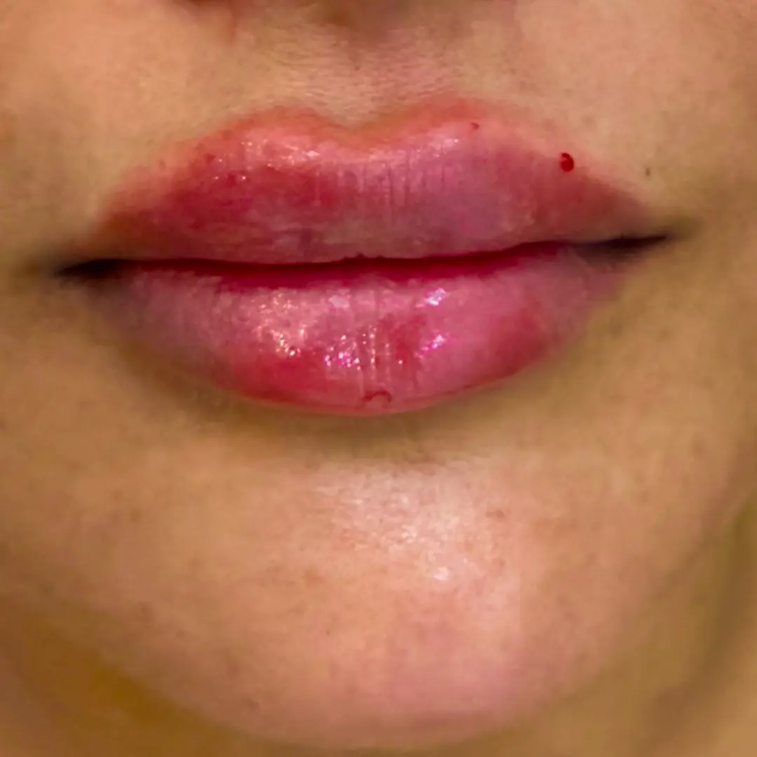 After Treatment